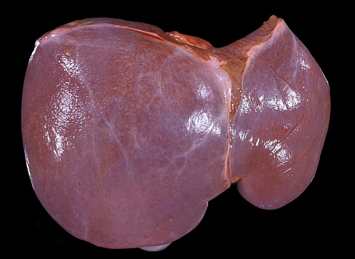 Congestive hepatopathy Human liver in a case of chronic passive hepatic congestion, a common complication of congestive heart failure, wherein elevated central venous pressure is directly transmitted from the right atrium to the hepatic veins. The liver is enlarged and shows a nutmeg pattern on its surface.