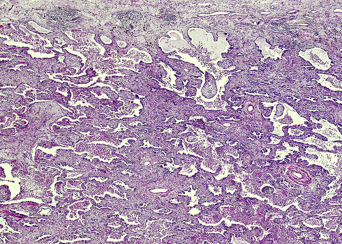 Small cell lung cancer, light micrograph Light micrograph section through human lung tissue showing small cell lung cancer  SCLC . It is a disease in which malignant cancer cells form in the tissues of the lung. Smoking is the major risk factor for small cell lung cancer. Signs and symptoms include coughing, shortness of breath and chest pain.