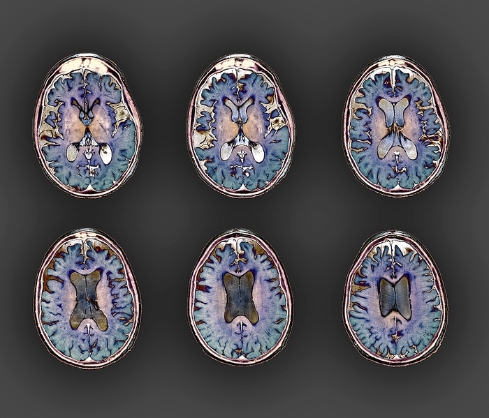 Early onset Alzheimer s disease, MRI scan Early onset Alzheimer s disease. Coloured magnetic resonance imaging  MRI  scans of the brain of a 53 year old patient with early onset Alzheimer s disease. Alzheimer s is a neurodegenerative disease that causes loss of brain mass, seen here as deep indentations around the front and sides of the brain. This brain shrinkage leads to memory loss, confusion, personality changes and ultimately death. Alzheimer s is usually a disease of old age, but it can develop earlier, particularly in the case of inherited forms.