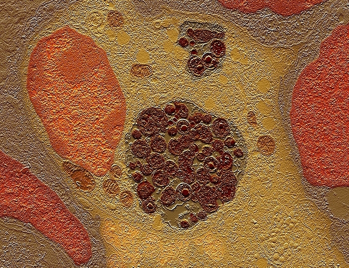 Chlamydia bacteria in a lung cell, TEM Chlamydia bacteria. Coloured transmission electron micrograph  TEM  of Chlamydia psittaci bacteria inside a lung cell. The brown area at centre is an inclusion body containing bacteria  dark brown  at different stages in their life cycle. At left is the cell s nucleus  orange . A second Chlamydia inclusion body is beginning to form at top centre. Chlamydia species bacteria are unusual in that they are obligate intracellular parasites, living and reproducing only inside cells. This species infects birds and livestock and can be transmitted to humans, where it can cause miscarriage and lung disease. Magnification: x8400 when printed at 10 centimetres wide.