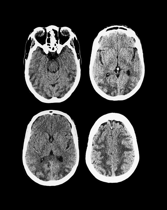 Eclampsia, MRI scan Eclampsia. Magnetic resonance imaging  MRI  scan of the brain of a 27 year old woman  from below , 7 days after giving birth  post partum . Eclampsia is the onset of seizures or unexplained coma during pregnancy or post partum. There are lesions  white  in several areas of the brain, but mainly in the frontal lobe  top . The lesions result from inflammation and reduced blood flow to the brain in preeclampsia, a condition that may lead to eclampsia.