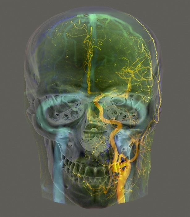 Blood supply of the head, 3D CT angiogram Blood supply of the head. Coloured frontal 3D computed tomography  CT  angiogram of the head of a healthy 38 year old man. Highlighted in yellow is the left internal carotid artery  centre right , which carries blood to the brain from the heart. At the level of the mandible  lower jaw , the left external carotid artery  right  branches off to supply blood to the outer periphery of the head. In blue is the brain s venous drainage system, which returns blood to the heart. Running down top to centre is the superior sagittal sinus. Curving around the sides of the skull are the transverse sinuses, leading to the sigmoid sinuses beneath the eye sockets and draining into the left and right jugular veins.