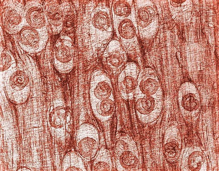 Worm infected tissue, light micrograph Worm infected tissue. Light micrograph of a section through human muscle tissue infested with parasitic Trichinella spiralis nematode worms  large, dark . Humans become infected with these parasites through eating undercooked pork products. The larvae migrate from the intestine to other tissues, where they form cysts  oval , in which they mature. The migration and encystment of these larvae can cause fever and pain brought upon by the host s inflammatory response. In some cases, migration to specific organ tissues can cause myocarditis  inflammation of heart muscle  and encephalitis  acute inflammation of the brain  that can result in death.
