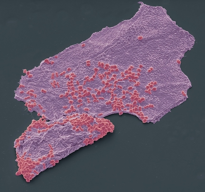 Skin bacteria, SEM Skin bacteria, Coloured scanning electron micrograph  SEM . Squamous skin cells covered in staphylococcus bacteria, one of roughly a thousand bacteria species present on human skin. One of the biggest challenges in treating staphylococcal infections is that many strains of the bacteria have developed resistance against a number of different antibiotics. Methicillin resistant Staphylococcus aureus  MRSA  is a strain of the bacterium resistant to an old antibiotic called methicillin, which is no longer used, and flucloxacillin, an antibiotic commonly used for skin infection. Infections caused by MRSA can be severe and may need treatment by an injectable antibiotic. Magnification: x 1500 when printed at 10 centimetres across.