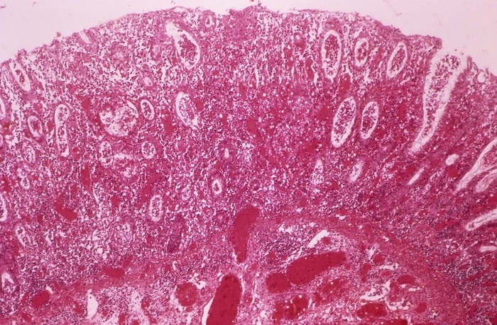 Ulcerative colitis, light micrograph Ulcerative colitis. Light micrograph of a section through a colon affected by ulcerative colitis. Ulcerative colitis is a form of inflammatory bowel disease characterised by inflammation of the bowel, typically arising in the rectum and often extending to involve part of, or most of, the large intestine. Treatment may require removal of all or part of the colon  colectomy .