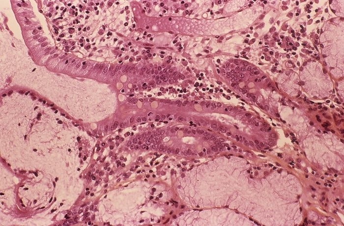 Secondary stomach cancer Secondary stomach cancer. Light micrograph of a section through cancer cells in the stomach. This cancer has spread  metastasised  from primary cancer of the colon.