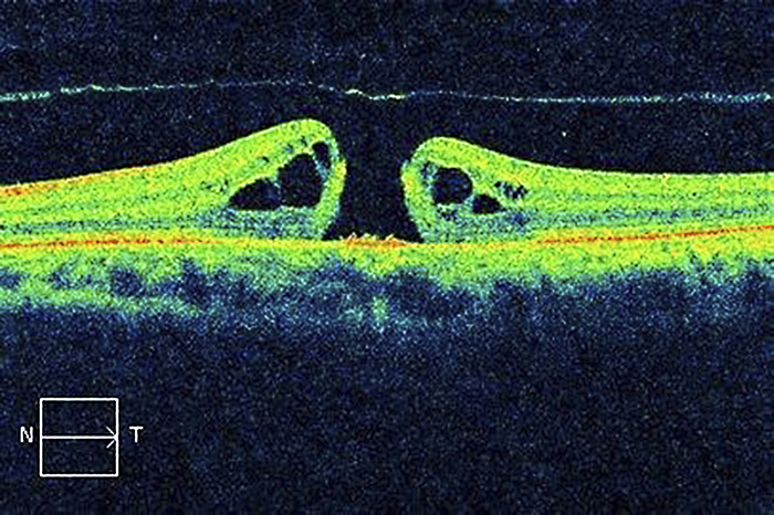 Macular hole, OCT scan Macular hole. Optical coherence tomography  OCT  scan of a section through the retina of the eye of a patient with a macular hole  centre . The retina is the light sensitive layer lining the inner surface of the eye that contains the rod and cone cells. The macula is the central area of the retina that contains the highest density of these cells. A macular hole is a small break in the macular. It is often caused by shrinking of the vitreous humor   the clear gel that fills the eyeball.