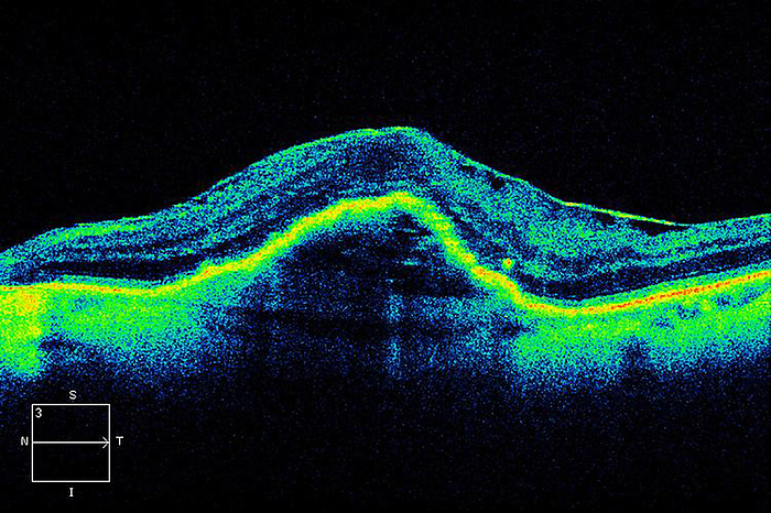 Macular degeneration, OCT scan Macular degeneration. Optical coherence tomography  OCT  scan of a section through the retina of the eye of a patient with age related macular degeneration  AMD . The retina is the light sensitive layer lining the inner surface of the eye that contains the rod and cone cells. The macula  centre  is the central area of the retina that contains the highest density of these cells. Degeneration of the macula results in the loss of site in the central field of vision. It is a major cause of blindness and visual impairment in older people.