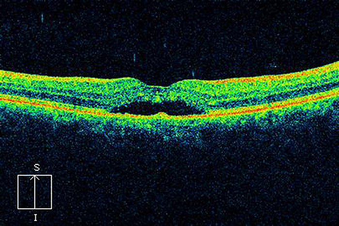 Macular degeneration, OCT scan Macular degeneration. Optical coherence tomography  OCT  scan of a section through the retina of the eye of a patient with age related macular degeneration  AMD . The retina is the light sensitive layer lining the inner surface of the eye that contains the rod and cone cells. The macula  centre  is the central area of the retina that contains the highest density of these cells. Degeneration of the macula results in the loss of site in the central field of vision. It is a major cause of blindness and visual impairment in older people.