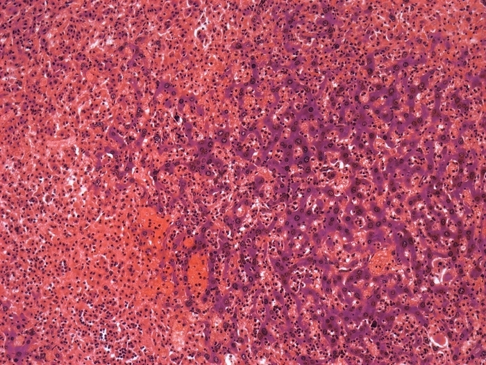 Liver cancer, light micrograph Liver cancer. Light micrograph of a section through a histiocytic sarcoma of the liver. Histiocytic sarcoma  HS  is an exceedingly rare malignancy in both children and adults. It is characterized by neo plastic cells with specific markers of histiocytic differentiation.  left of image  The disease carries a dismal prognosis when patients present with advanced stage disease. Because of the poor response rates to conventional chemotherapy and the rarity of the disease, no standard of care exists for patients with HS. Magnification: x150 when printed at 10 centimetres wide. Human tissue.
