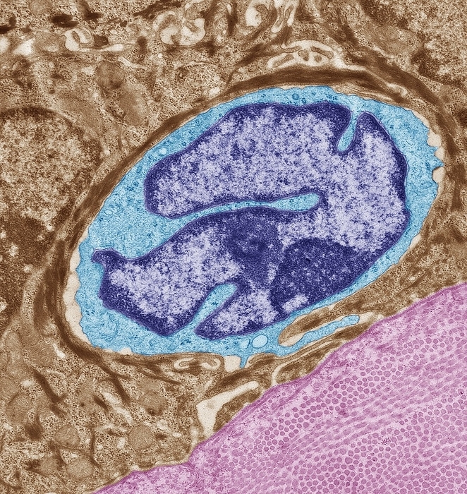 Langerhans cell, TEM Langerhans cell. Coloured transmission electron micrograph  TEM  of a section through the skin to show a Langerhans cell  blue . The function of these cells is to detect foreign bodies  antigens  which have penetrated the epidermis, capturing intruders and then carrying them to the lymph nodes in the dermis, where they are presented to the lymphocytes. A cellular type of immune response is then triggered, neutralising and finally eliminating the antigen. Keratinocytes  brown  surround the Langerhans cell and dermis  pink  is seen at bottom right of the image. Magnification: x7000 when printed at 10 centimetres high.