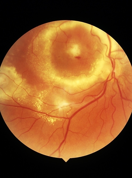 Chorioretinitis in viral infection Chorioretinitis in viral infection. Fundus image of the interior surface of the eye of a patient with chorioretinitis caused by cytomegalovirus infection. Chorioretinitis is the inflammation of the choroid and retina of the eye. It is often caused by toxoplasmosis and cytomegalovirus infection.