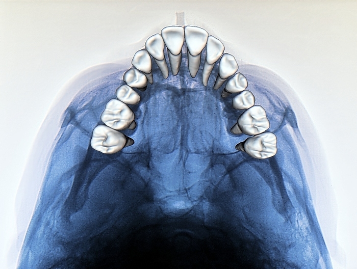Dental arch in thumb sucking, X ray Dental arch in thumb sucking. Coloured X ray of the dental arch of a 19 year old patient, showing evidence of deformation due to thumb sucking as a child. Thumb sucking can affect the shape of the oral cavity and or dentition once a child s permanent teeth begin to come through.
