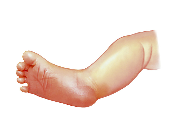 Postpartum gestational age assessment Illustration of a newborn s leg. Assessment of certain physical characteristics can be used to ascertain gestational age. If using Usher s criteria, this can include the number of creases on the sole of the foot. This illustration is from Asklepios Atlas of the Human Anatomy .
