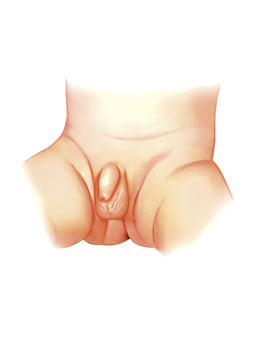 Postpartum gestational age assessment Illustration of a newborn boy s genitals. Assessment of certain physical characteristics can be used to ascertain gestational age. If using Usher s criteria, this can include the position and appearance of the genitals. This illustration is from Asklepios Atlas of the Human Anatomy .