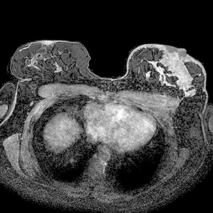 Secondary breast cancer, MRI Secondary breast cancer. Magnetic resonance imaging  MRI  scan of a transverse section through the chest of a 49 year old female patient with a malignant  cancerous  tumour  white, upper right  in the left breast  right  that has metastasised  spread  from liver cancer.