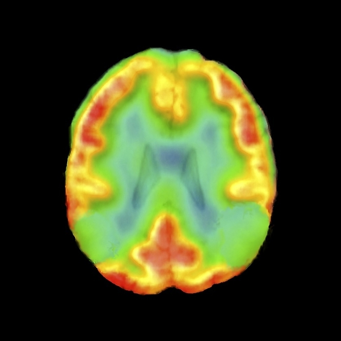 Brain in Alzheimer s disease, SPECT Brain in Alzheimer s disease. Single photon emission computed tomography  SPECT  scan of axial sections through the brain of a 73 year old patient, showing reduced blood flow  red orange  and therefore metabolic activity, in the parietal cortex  lower left and right , indicative of atrophy  wasting  associated with Alzheimer s disease.