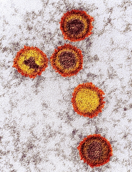 Epstein Barr virus particles, TEM Coloured transmission electron micrograph  TEM  of Epstein Barr virus  EBV  particles in Burkitt s lymphoma. Each particle consists of a deoxyribonucleic acid  DNA  core  purple  surrounded by an icosahedral capsid  yellow , which is itself surrounded by an envelope covered in glycoprotein spikes  orange . EBV, also known as human herpes virus 4, is 1 of 5 herpes viruses that infects humans. It is best known as the cause of infectious mononucleosis  glandular fever , but is also associated with some forms of cancer, including Burkitt s lymphoma. In both infections, the virus infects one type of white blood cell, the B lymphocytes. Infection with EBV is common and usually harmless  additional factors potentiate the development of more serious diseases. Magnification: x135,000 when printed at 10 centimetres tall.