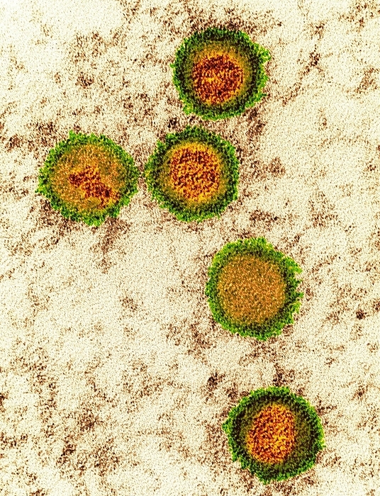 Epstein Barr virus particles, TEM Coloured transmission electron micrograph  TEM  of Epstein Barr virus  EBV  particles in Burkitt s lymphoma. Each particle consists of a deoxyribonucleic acid  DNA  core  red  surrounded by an icosahedral capsid  orange , which is itself surrounded by an envelope covered in glycoprotein spikes  green . EBV, also known as human herpes virus 4, is 1 of 5 herpes viruses that infects humans. It is best known as the cause of infectious mononucleosis  glandular fever , but is also associated with some forms of cancer, including Burkitt s lymphoma. In both infections, the virus infects one type of white blood cell, the B lymphocytes. Infection with EBV is common and usually harmless  additional factors potentiate the development of more serious diseases. Magnification: x135,000 when printed at 10 centimetres tall.