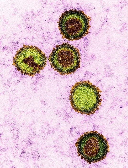 Epstein Barr virus particles, TEM Coloured transmission electron micrograph  TEM  of Epstein Barr virus  EBV  particles in Burkitt s lymphoma. Each particle consists of a deoxyribonucleic acid  DNA  core  brown  surrounded by an icosahedral capsid  green , which is itself surrounded by an envelope covered in glycoprotein spikes  yellow  EBV, also known as human herpes virus 4, is 1 of 5 herpes viruses that infects humans. It is best known as the cause of infectious mononucleosis  glandular fever , but is also associated with some forms of cancer, including Burkitt s lymphoma. In both infections, the virus infects one type of white blood cell, the B lymphocytes. Infection with EBV is common and usually harmless  additional factors potentiate the development of more serious diseases. Magnification: x135,000 when printed at 10 centimetres tall.