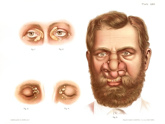 Xanthelasma and rhinoscleroma, illustration Xanthelasma and rhinoscleroma. Historical medical illustration showing xanthelasma  Figs. 1 4  and rhinoscleroma  Fig. 5 . In xanthelasma, fatty deposits of yellowish cholesterol collect beneath the skin, and are a symptom of a high blood cholesterol. Rhinoscleroma is caused by infection with the bacterium Klebsiella rhinoscleromatis, which causes deformity and tissue destruction in the nasal area. From Atlas of Venereal and Skin Diseases by Prince Albert Morrow, published in 1889.