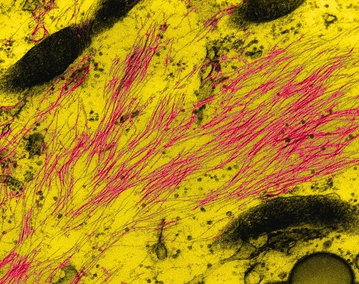 Neurofilaments in a glial cell, TEM Neurofilaments in a neuroglial cell   astrocyte  mammal central nervous system , coloured transmission electron micrograph  TEM . A neurofilament is an element of the cytoskeleton that is specific to neurons. Neurofilaments are similar to cytoskeletal elements in other cells, but they are made up of a different set of proteins. They are especially numerous in the axons  long extensions of neurons  that generally transmit nerve impulses away from the cell body toward other cells. Several neurological disorders are directly linked to overproduction of neurofilaments. Magnification: x18, 950 when shortest axis printed at 25 millimetres.