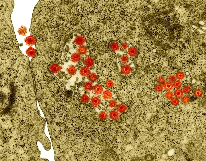 Herpes simplex virus, TEM Herpes simplex virus  HSV 2, DNA virus  in cellular vacuoles and cytoplasm of peripheral blood lymphocyte  Herpesviridae Family , coloured transmission electron micrograph  TEM . Two virus particles are seen adjacent to the cell membrane in the upper left of the image. The membrane near each virus is depressed and clatharin coated. Herpes simplex is a viral infection. Herpes simplex virus exhibits the classical receptor mediated endocytosis of virus particles. HSV 1 produces most cold sores. HSV 2 causes most of the genital herpes cases. HSV 6 causes neuroinflammatory diseases such as multiple sclerosis, encephalitis and pneumonitis. Magnification: x7,125 when shortest axis printed at 25 millimetres.