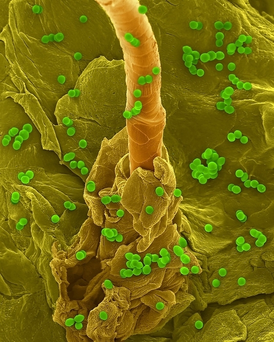 Enterococcus faecium on human skin, SEM Coloured scanning electron micrograph  SEM  of Photocomposite, Enterococcus faecium on the surface of human skin and hair follicle. Human skin  epidermis  with hair emerging from hair follicle. Numerous desquamating cells are concentrically arranged around the base of the hair shaft. Enterococcus faecium  also known as Streptococcus faecium , Gram positive, vancomycin resistant  VRE , coccus prokaryote that grows in groups or chains. E. faecium is commonly found in the guts of humans and other animals. It does not normally cause disease, but can be an opportunistic pathogen when the immune system is impaired. It is an important nosocomial  hospital acquired  pathogen. E. faecium is known to have a resistance to several types of antibiotics including gentamicin, tetracycline, erythromycin, teicoplanin and penicillin. Magnification: x800 bacteria  x260 skin when shortest axis printed at 25 millimetres.