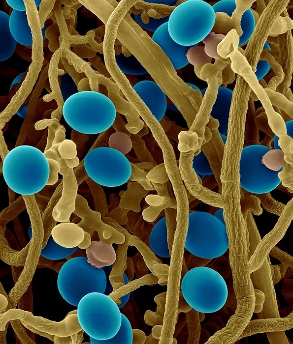 Sporulating fungus Nigrospora oryzae, SEM Coloured scanning electron micrograph  SEM  of Sporulating, filamentous fungus  Nigrospora oryzae . Filamentous hyphae are seen producing conidiophores with conidia  blue  at the tips. Nigrospora oryzae  teleomorph or sexual stage is known as Khuskia oryzae  is a plant pathogen that causes disease in corn called Nigrospora Ear Rot or Cob Rot. Nigrospora Ear Rot is widely distributed but the extent of its prevalence varies greatly from year to year throughout the world. Nigrospora oryzae can also infect rice and sorghum. It is also known to infect cotton causing Nigrospora Lint Rot and also cane plants causing Foliar or Cane Rot. Magnification: x240 when shortest axis printed at 25 millimetres.