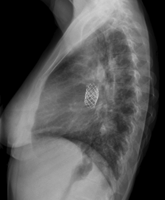 Congenital heart defects, X ray Congenital heart defects. Lateral X ray of the chest of a 23 year old woman who was born with congenital heart defects. These included transposition of the great vessels  TGV  and ventricular septal defect  VSD . The patient had operations as a child to treat these conditions. The valved stent visible on this X ray  above centre  was implanted to help the heart function despite the right ventricular hypertrophy which has developed progressively since childhood. Hypertrophic cardiomyopathy is where the myocardium  heart muscle  increases in size, seen on this X ray as an enlarged heart.