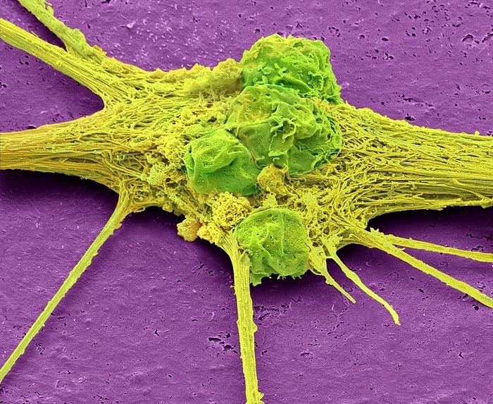 Neurone, SEM Stem cell derived neuron. Coloured scanning electron micrograph  SEM  of a human nerve cell  neuron  that has been derived from an embyonic pluripotent stem cell  ES . Pluripotent stem cells are able to differentiate into any of the 200 cell types in the human body. The type of cell they mature into depends upon the biochemical signals received by the immature cells. This ability makes them a potential source of cells to repair damaged tissue in diseases such as Parkinson s and insulin dependent diabetes. Magnification: x2650 when printed 10 centimetres wide.