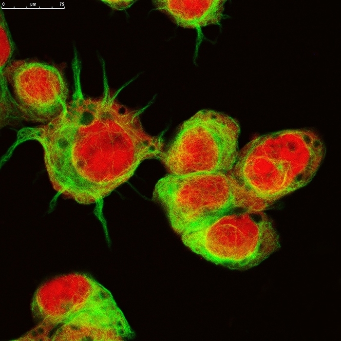 Neuroblastoma cells, fluorescence light micrograph Neuroblastoma cells. Fluorescence light micrograph of cells from a type of brain cancer  neuroblastoma  in a human patient. The cells are stained for cell nuclei  DNA, red  and cellular microfilaments  green . Cancer cells spread in the body with the help of mutated genes that drive changes in the cytoskeleton of the cells, the protein filaments and microtubules that control cell shape and contribute to cell movement. Study of the mechanisms by which cancer cells move through the body may lead to targeted therapies that reverse these processes. Neuroblastoma is a common cancer in very young children. It arises from cells in the sympathetic nervous system. Magnification: x250 when printed at 10 centimetres across.