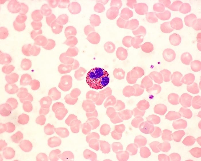 Eosinophil, light micrograph Light micrograph showing an eosinophil in a blood smear. Erythrocytes  red blood cells  are pink. The eosinophil exhibits the characteristic bilobulated nucleus and the red cytoplasmic granules stained by eosin. Among the red blood cells are some small platelets with a somewhat bluish staining. Magnification: x900 when printed at 10 centimetres across.
