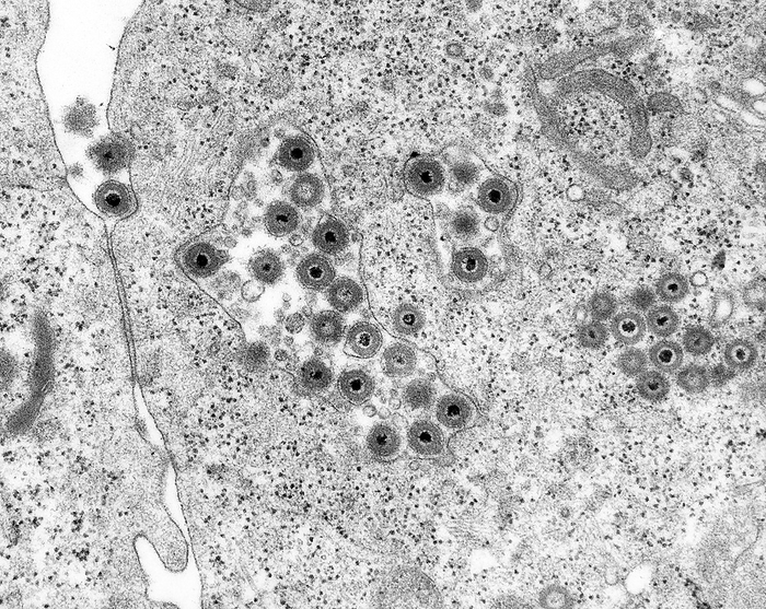 Herpes simplex virus, TEM Herpes simplex virus  HSV 2, DNA virus  in cellular vacuoles and cytoplasm of peripheral blood lymphocyte  Herpesviridae Family , transmission electron micrograph  TEM . Two virus particles are seen adjacent to the cell membrane in the upper left of the image. The membrane near each virus is depressed and clatharin coated. Herpes simplex is a viral infection. Herpes simplex virus exhibits the classical receptor mediated endocytosis of virus particles. HSV 1 produces most cold sores. HSV 2 causes most of the genital herpes cases. HSV 6 causes neuroinflammatory diseases such as multiple sclerosis, encephalitis and pneumonitis. Magnification: x7,125 when shortest axis printed at 25 millimetres.