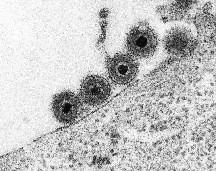 Herpes simplex virus, TEM Herpes simplex virus  HSV 2, DNA virus  on a peripheral blood lymphocyte  Herpesviridae Family , transmission electron micrograph  TEM . Herpes simplex is a viral infection. Herpes simplex virus exhibits the classical receptor mediated endocytosis of virus particles. HSV 1 produces most cold sores. HSV 2 causes most of the genital herpes cases. HSV 6 causes neuroinflammatory diseases such as multiple sclerosis, encephalitis and pneumonitis. Magnification: x23,280 when shortest axis printed at 25 millimetres.