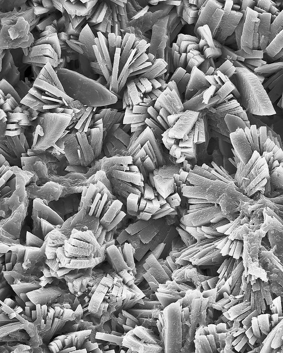 Kidney stone monoclinic crystals, SEM Kidney stone, scanning electron micrograph  SEM . Kidney stones are primarily formed by crystallization of the mineral salt calcium oxalate from the urine. They are irregular shaped stones called calculi  calculus  and are composed of random oriented columnar monoclinic crystals of calcium oxalate monohydrate  seen here  with peripheral deposits of fine octahedral crystals of calcium oxalate dehydrate. Patches of microcrystalline hydroxyl apatite fill internodal regions. Protein matrices can also be associated with the microcrystalline arrays. The hard stones can cause severe pain as they pass down the ureter  urinary tract . Kidney stones may need to be removed surgically using ultrasound. Magnification: x600 when shortest axis printed at 25 millimetres.