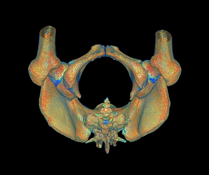 Female pelvis, illustration Female pelvis. Illustration based on a 3D computed tomography  CT  scan of the pelvis of a woman s skeleton, seen from below with the front of the pelvis at top. The bones of the pelvis articulate with the femur bones  upper right and upper left  to form the hip joints. The rear of the pelvis  lower centre  is formed of the sacrum and the coccyx. The main pelvic bones are known as the coxal bones, and consist of the ilium, ischium, and pubis. In women, the pelvis is a different shape to that in men, due to the anatomical requirements of childbirth.
