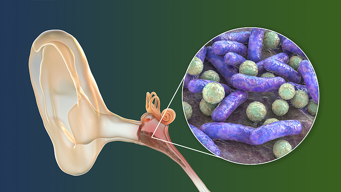 Otitis media ear infection, illustration Otitis media ear infection and close up view of bacteria, the etiological agents of the middle ear inflammation, conceptual computer illustration. Acute otitis media is characterized by acute onset of signs such as ear pain and middle ear effusion. The most common bacterial causes are Streptococcus pneumoniae, Haemophilus influenzae, Moraxella catarrhalis, and Streptococcus pyogenes., by KATERYNA KON SCIENCE PHOTO LIBRARY