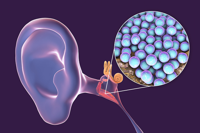 Otitis media ear infection, illustration Otitis media ear infection caused by Staphylococcus aureus bacteria, conceptual computer illustration. S. aureus is one of the commonest causes of chronic suppurative otitis media and is less frequently isolated in acute otitis media, as well as in chronic otitis media with effusion., by KATERYNA KON SCIENCE PHOTO LIBRARY