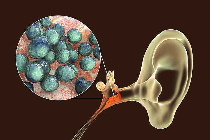 Otitis media ear infection, illustration Otitis media ear infection caused by Staphylococcus aureus bacteria, conceptual computer illustration. S. aureus is one of the commonest causes of chronic suppurative otitis media and is less frequently isolated in acute otitis media, as well as in chronic otitis media with effusion., by KATERYNA KON SCIENCE PHOTO LIBRARY