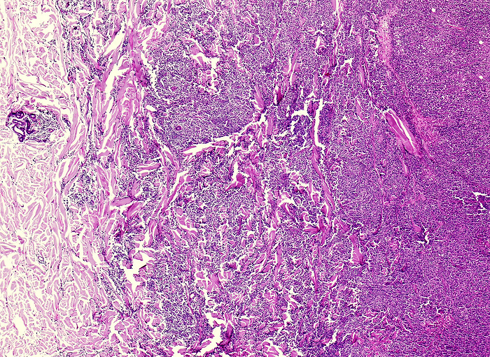Non Hodgkin s lymphoma, light micrograph Light micrograph section through human tissue showing  Hodgkin s lymphoma. This is a type of cancer that affects the lymphatic system, a network of vessels and glands found throughout the body. The main symptom is swollen glands that persist. Treatments range from chemotherapy to anti cancer medicines called monoclonal antibodies. The disease is more common in people who have a weakened immune system., by NIGEL DOWNER SCIENCE PHOTO LIBRARY