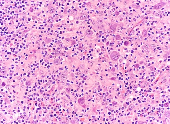 Nodular sclerosis Hodgkin lymphoma, light micrograph Light micrograph of Hodgkin lymphoma, nodular sclerosis subtype. Numerous Reed Sternberg cells and Hodgkin cells are present in a background of a mixed inflammatory infiltrate of eosinophils, neutrophils, lymphocytes, plasma cells, and histiocytes., by WEBPATHOLOGY SCIENCE PHOTO LIBRARY