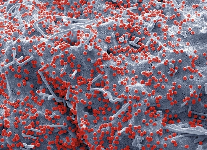 HIV infected 293T cell, SEM HIV infected 293T cell. Coloured scanning electron micrograph  SEM  of a 293T cell infected with the human immunodeficiency virus  HIV, red dots . Small spherical virus particles, visible on the surface, are in the process of budding from the cell membrane. Any non highlighted vesicles of uneven shape are exosomes, thought to be involved in cell communication, transmission of disease and are being investigated as a means of drug delivery. Because 293T cells have lost their ability to protect themselves from viral infection, something that all cells are normally very good at, 293T are easily transfected, or infected, and can be used to produce large amounts of virus. This makes these cells an extraordinarily valuable tool in medicine and research. Magnification x 12,000 at 10cm wide. Specimen courtesy of Greg Towers, UCL.