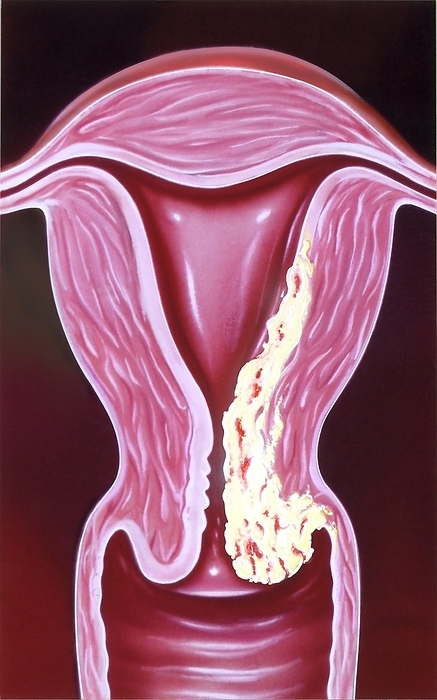 Invasive cancer of the cervix, illustration Invasive cancer of the cervix. Illustration of a coronal section through the uterus  womb , showing malignant  cancerous  tissue  white  on the cervix  neck of the womb . The cancer has spread  metastasised  to the wall of the uterus. Symptoms of this cancer include bleeding between periods, pain after sexual intercourse and heavier periods. Cancer of the cervix is rare and if detected early is almost always cured. If it has progressed to the stage where it has spread, it can be fatal. Treatment is surgical removal of the cancer, and sometimes the entire uterus, combined with radiotherapy and chemotherapy.