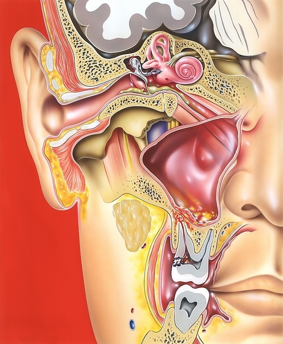 Middle ear, tooth and sinus infections, illustration Middle ear, tooth and sinus infections. Illustration of a cutaway view of the right side of the head, showing the ear, a maxillary sinus, and two molar teeth. Infections are present, in the middle ear  otitis media  and in a tooth and the maxillary sinus  dental caries and sinusitis . The ear drum  tympanic membrane  has been perforated, with pus  green  leaking out from the middle ear to the outer ear. The area of decay in the tooth  black  has spread to the tooth s root and nerve, then to the bone, and from there into the adjacent sinus. Inflammation and pus  yellow  are seen in the sinus. The maxillary sinus is one of the membrane lined cavities known as the paranasal sinuses.