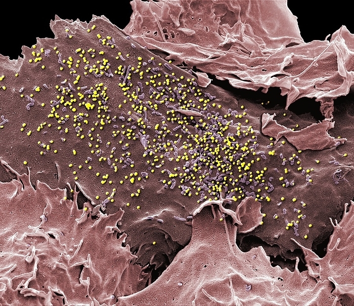 HIV infected cell, SEM HIV infected 293T cell. Coloured scanning electron micrograph  SEM  of a 293T cell infected with the human immunodeficiency virus  HIV, yellow dots . Small spherical virus particles, visible on the surface, are in the process of budding from the cell membrane. Any non highlighted vesicles of uneven shape are exosomes, thought to be involved in cell communication and transmission of disease, and under investigation as a means of drug delivery. Because 293T cells have lost their ability to protect themselves from viral infection, something that all cells are normally very good at, 293T are easily transfected, or infected, and can be used to produce large amounts of virus. This makes these cells an extraordinarily valuable tool in medicine and research. Magnification x 5500 at 10cm wide. Specimen courtesy of Greg Towers, UCL.