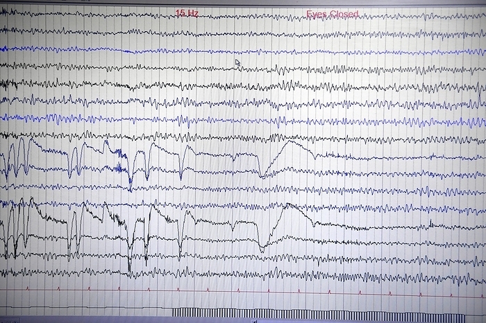 Brain waves recorded on an EEG Brain waves recorded on an electroencephalogram  EEG , showing the results at 15 Hertz with the eyes closed. An EEG measures the electrical activity of the brain  brain waves  using electrodes attached to the scalp. Various disorders can be diagnosed by analysing EEG results. These results are from a 30 year old woman.