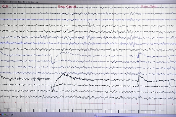Brain waves recorded on an EEG Brain waves recorded on an electroencephalogram  EEG , showing the results at 2 Hertz with the eyes open and then closed. An EEG measures the electrical activity of the brain  brain waves  using electrodes attached to the scalp. Various disorders can be diagnosed by analysing EEG results. These results are from a 30 year old woman.
