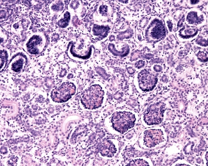 Developing kidney, light micrograph Light micrograph showing two phases of developing glomeruli. At top, glomeruli show immature capillary loops covered by a dark crescent of podocytes which bulge into the Bowman s space. In the bottom half, the capillary loops are more differentiated, and renal tubules appear among glomeruli. Magnification: x180 when printed at 10 centimetres wide.