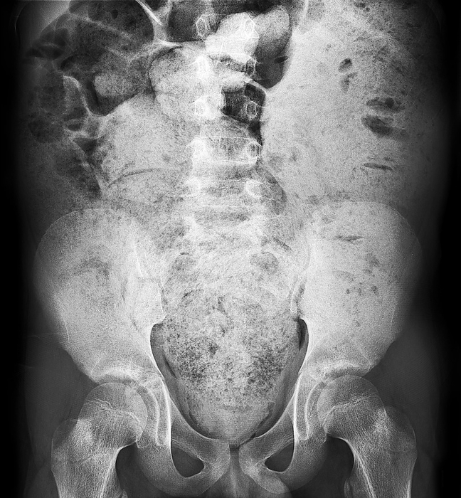 Bowel obstruction, X ray Bowel obstruction, X ray. The image shows dilatation of the large bowel and massive faecal loading, caused by the bowels not opening properly.